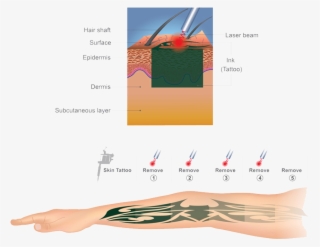 Colaz Tattoo Removed - Tattoo #9436337