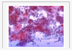 Yeast And Hyphae In Distal Esophagus Brush - Esophagus #958600