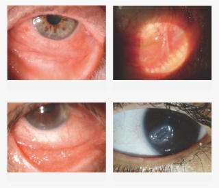 Ocular Surface Disease - Close-up #9538152