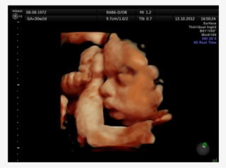 Immobile Fetus At 31 Weeks - Ultrasound 4d 31 Week #9542627
