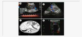 Fetus With Multiple Hemangiomas In The Whole Liver - Computed Tomography #9542777 Fetus With Multiple Hemangiomas In The Whole Liver - Computed Tomography #9542777