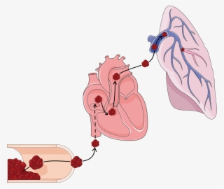 1351 X 1140 5 - Pulmonary Embolism Clipart #9565236