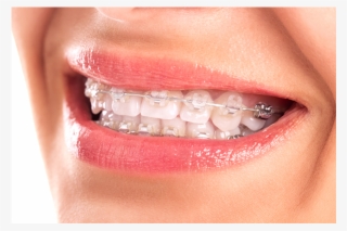 Brackets-esteticos - White Braces #9566750