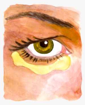 Diagram Of Fatty Bags And Incisions - Sv Plastinės Chirurgijos Centras #966349