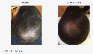 Male 20y, Androgenic Alopecia / Male Patterned Balding #977333