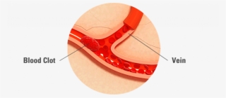 Blood Clots Are Thickened Clumps Of Blood That Can - Wood #9713950