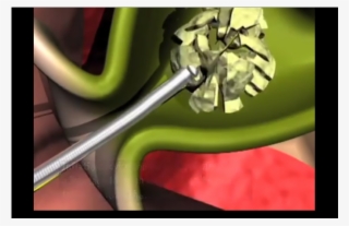 Flexible Yet Sturdy Catheter Is Designed To Bend With - Cable #9753354