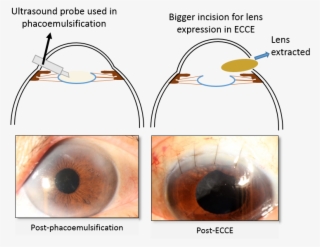 Cataract Surgery - Circle #9768941