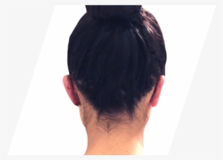 After Ear Surgery - Girl #9769371