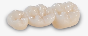 Bruxzir Anterior Crowns & Bridges - Crown #982606
