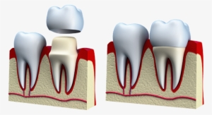Crowns & Bridges - Crowns Bridges And Veneers #982731
