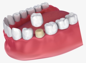 Digital Image Of A Dental Crown Being Placed - Dental Crown #982734