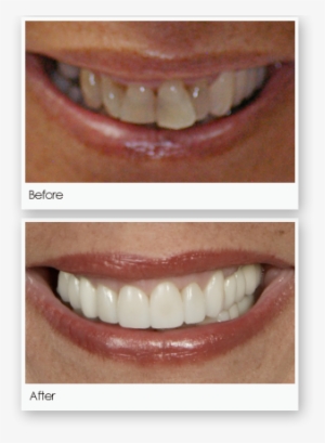 Crowns - Lieberman Larry T Dds Pa #982954