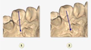 File - Maestro3d - Dental - Studio - Mesio - Distal3 - Diagram #9817693