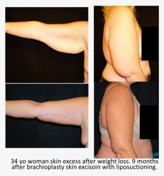 Arm Lift - Photo Caption #9878432