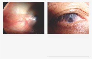 Ocular Surface Disease - Pterygium #993978